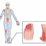 What is Psoriatic Arthritis