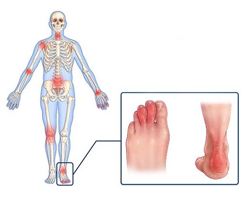 What is Psoriatic Arthritis