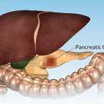 warning signs of pancreatic cancer