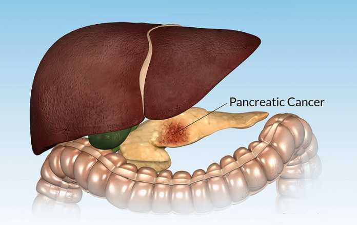 warning signs of pancreatic cancer