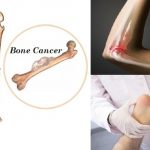 Symptoms of Bone Cancer