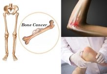 10 Warning Signs of Bone Cancer You Should Never Ignore Symptoms of Bone Cancer