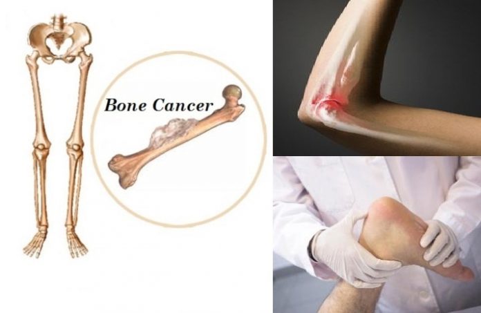 Symptoms of Bone Cancer