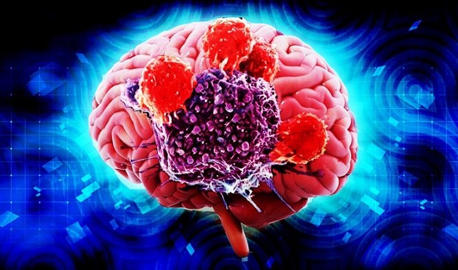 brain cancer symptoms of Brain Cancer