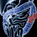 Strange Symptoms of Colon Cancer