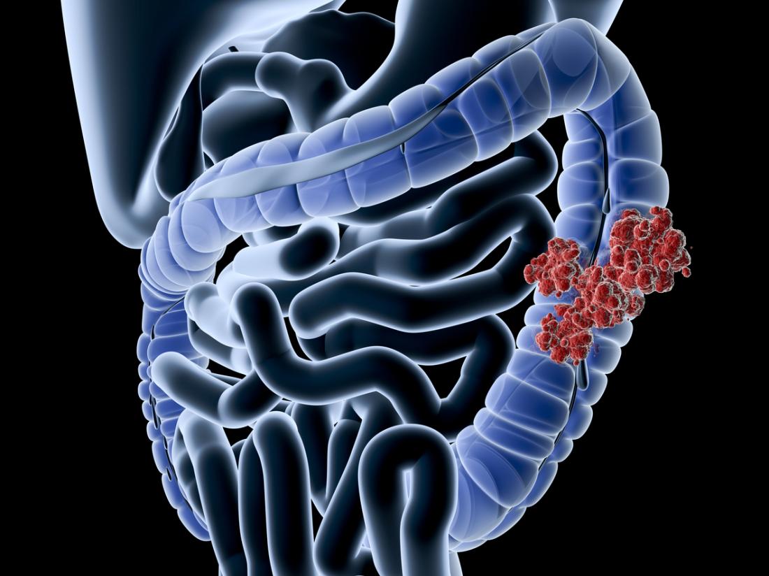 Strange Symptoms of Colon Cancer