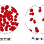 symptoms of anemia