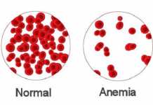 10 Warning Symptoms of Anemia You Should Never Ignore symptoms of anemia