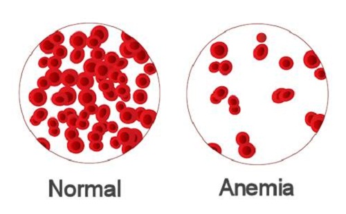 NF-Anemia symptoms of anemia