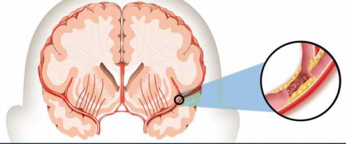 Symptoms of Stroke