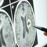 brain tumor diagnosis