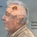 symptoms of brain tumors