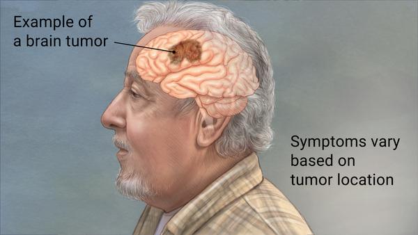 brain tumor symptoms of brain tumors