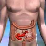 Symptoms of Colon Cancer