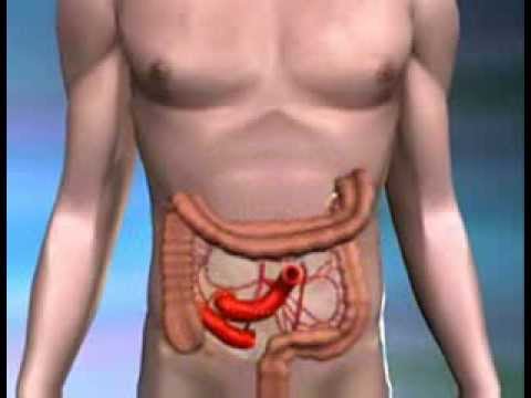 Symptoms of Colon Cancer