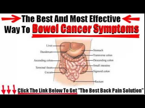 Bowel Cancer Symptoms