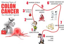 Symptoms of Colon Cancer