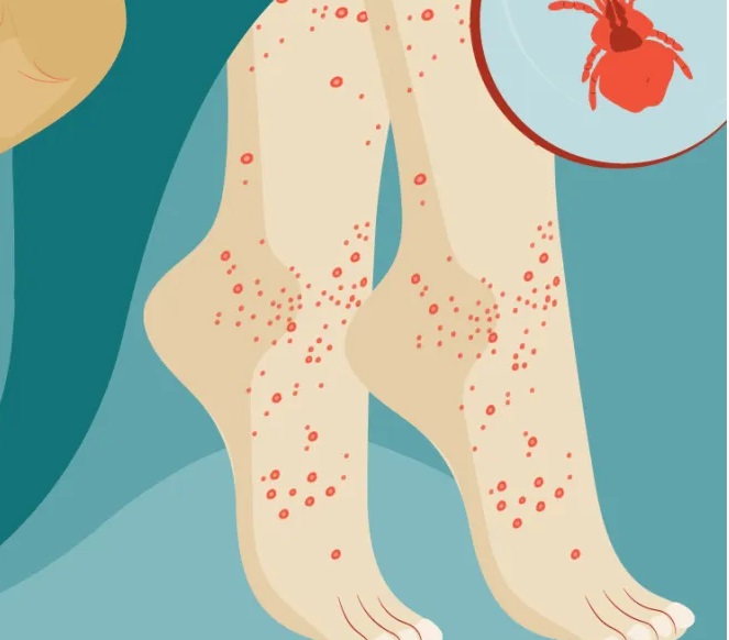 How to Identify and Treat the Itchy Culprits