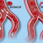 Understanding Sickle Cell Symptoms: What to Look Out For