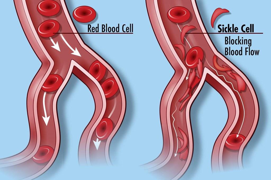 Understanding Sickle Cell Symptoms: What to Look Out For