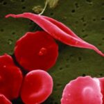 Breakthrough Sickle Cell Disease Treatment Shows Promising Results in Clinical Trials