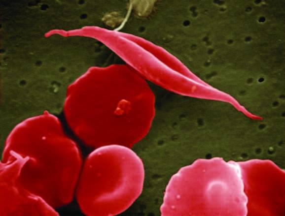 Breakthrough Sickle Cell Disease Treatment Shows Promising Results in Clinical Trials