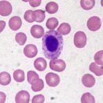Recognizing the Signs of Severe Anemia: What to Look Out For