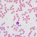 Recognizing the Symptoms of Hemolytic Anemia: What You Need to Know