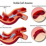 The often overlooked symptoms of sickle cell trait in adults