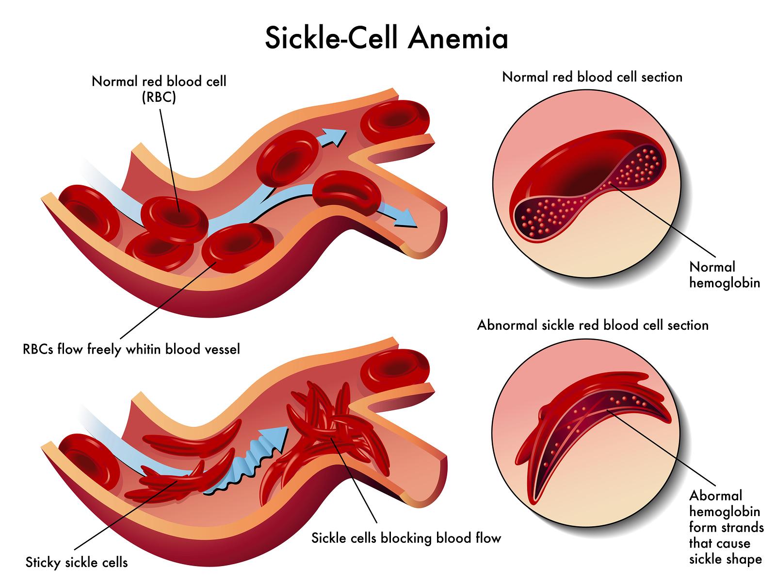 The often overlooked symptoms of sickle cell trait in adults