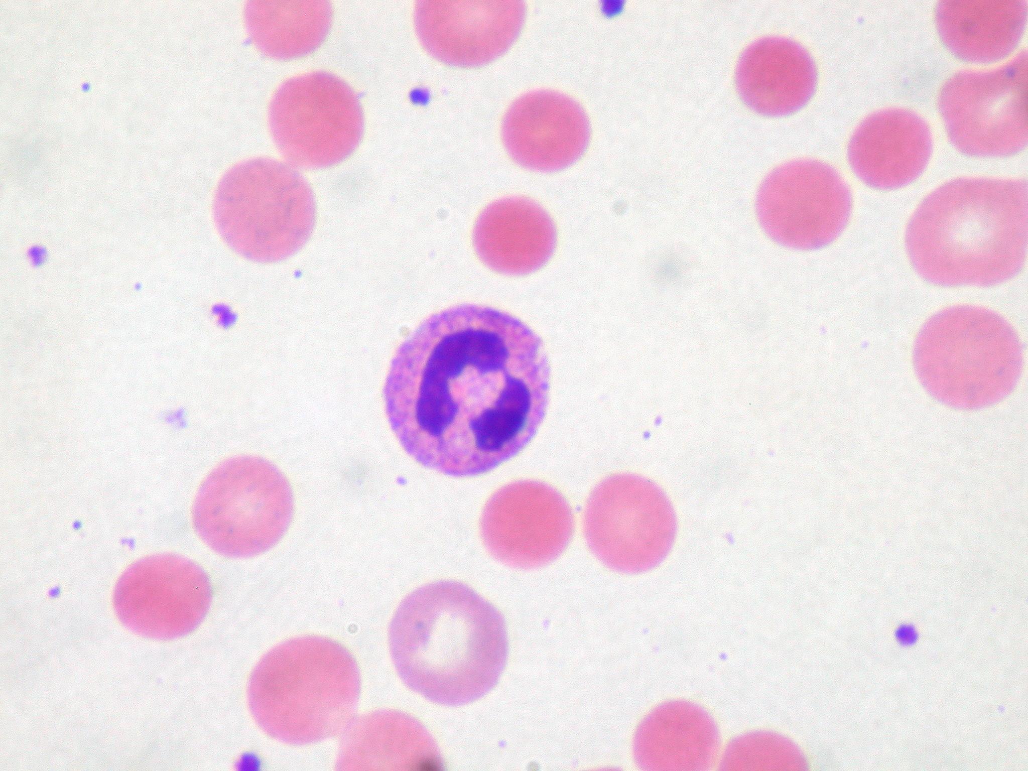 Understanding Chronic Anemia: Causes, Symptoms, and Treatment Options