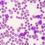 Understanding Autoimmune Anemia: Causes, Symptoms, and Treatment Options