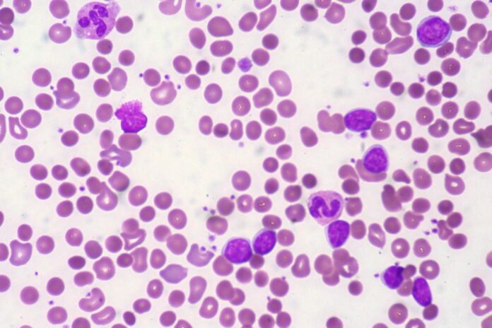 Understanding Autoimmune Anemia: Causes, Symptoms, and Treatment Options