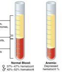 Understanding the Link Between Low Red Blood Cell Count and Cancer