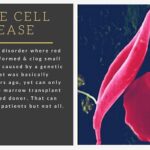 Understanding Sickle Cell Disease: Symptoms, Causes, and Treatment Options