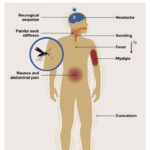 Understanding the Symptoms and Treatment Options for Stage 4 Bone Cancer