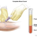 New Blood Test Offers Early Detection of Bone Cancer