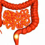 Ulcerative Colitis