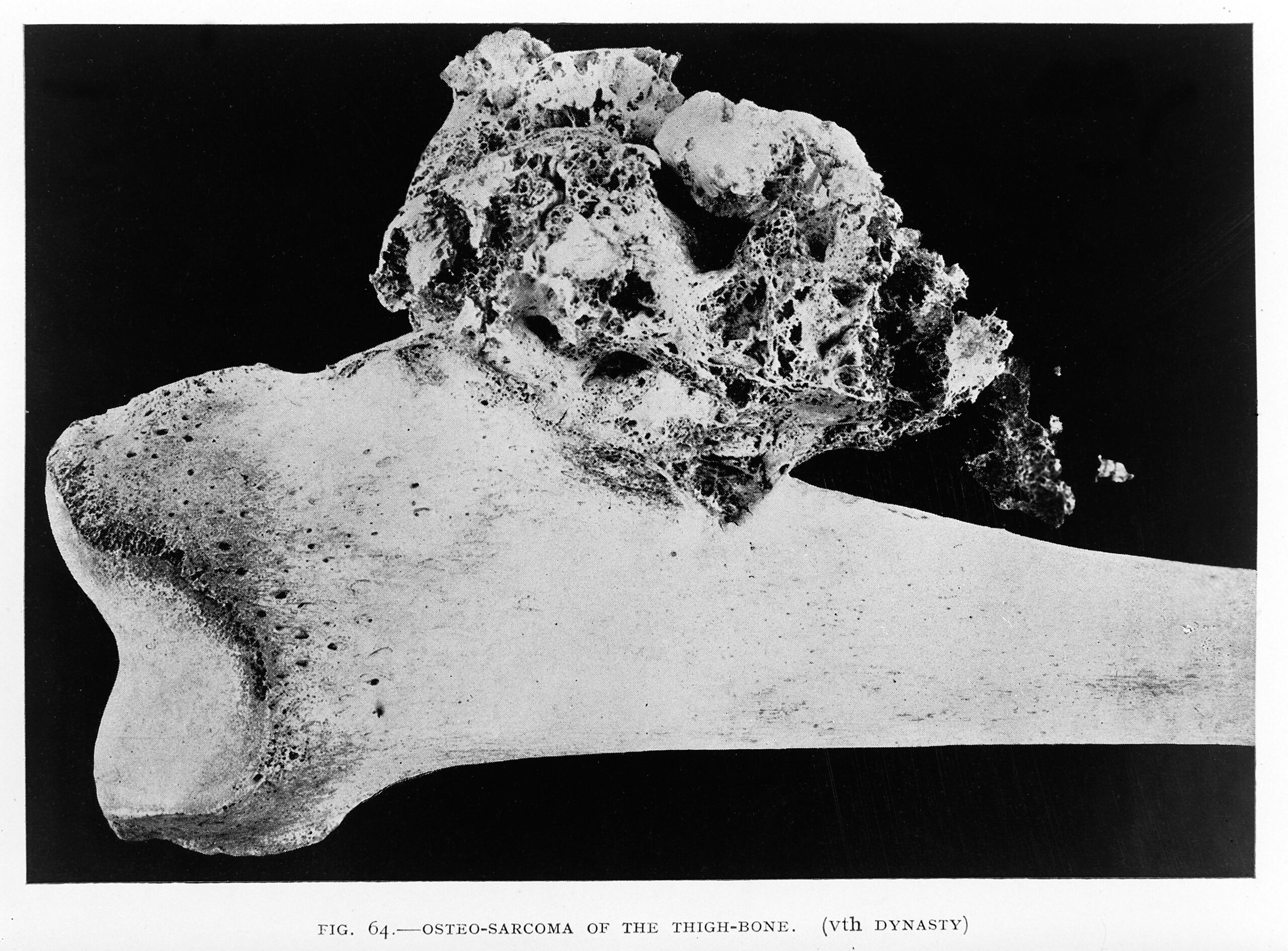 Understanding Osteosarcoma: The Most Common Form of Bone Cancer