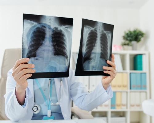 Understanding Stage 4 Lung Cancer: Symptoms, Treatments, and Prognosis