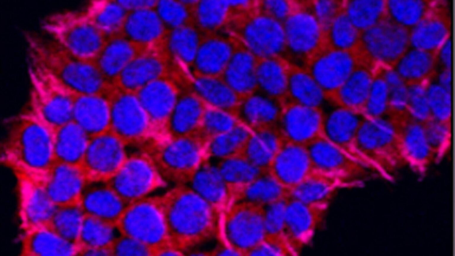 Understanding the Differences Between Lung Cancer and Pneumonia