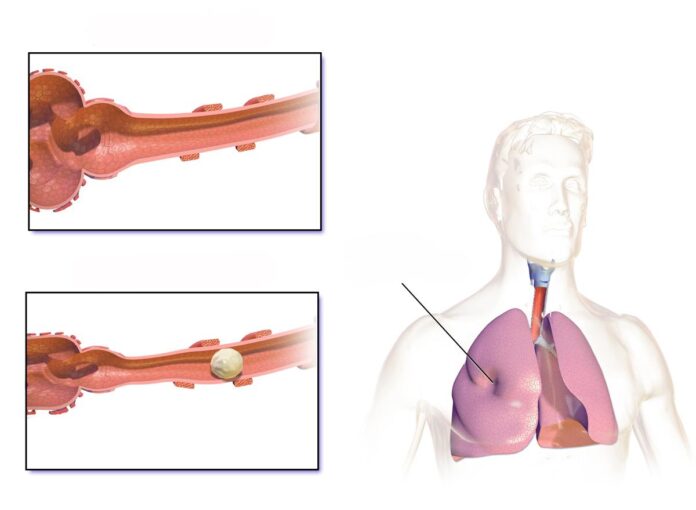 Understanding the Link Between Atelectasis and Lung Cancer: What You Need to Know