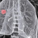 Understanding the Importance of Biopsy in Diagnosing Lung Cancer