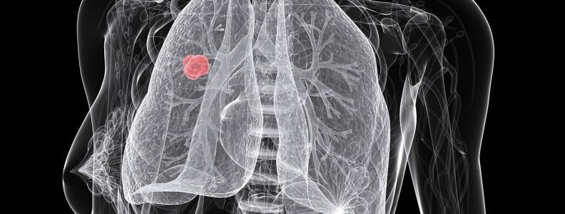 Understanding the Importance of Biopsy in Diagnosing Lung Cancer