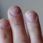 What Your Fingernails Can Reveal About the Risk of Lung Cancer