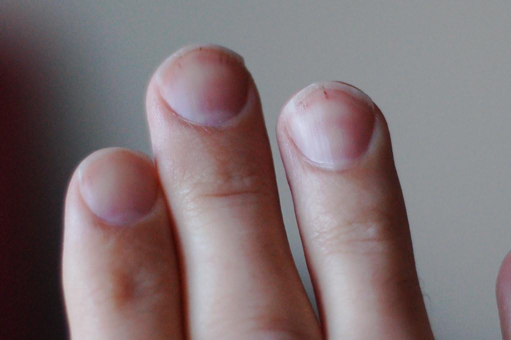 What Your Fingernails Can Reveal About the Risk of Lung Cancer