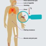 10 Symptoms of Crohnʼs disease You Should Never Ignore