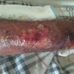 10 Symptoms of anthrax You Should Never Ignore