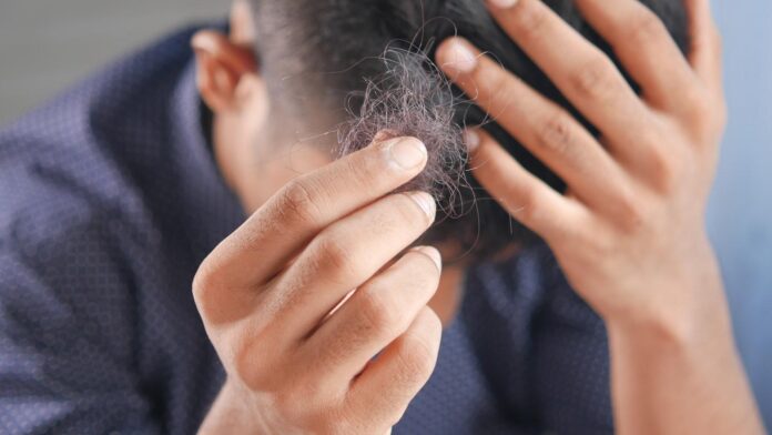 10 Symptoms of alopecia areata You Should Never Ignore