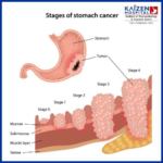 10 Symptoms of stomach cancer You Should Never Ignore